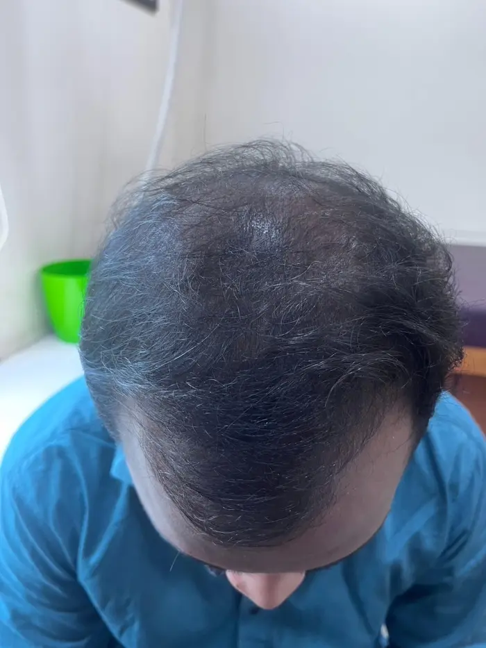 Male Pattern Baldness case 3 after treatment